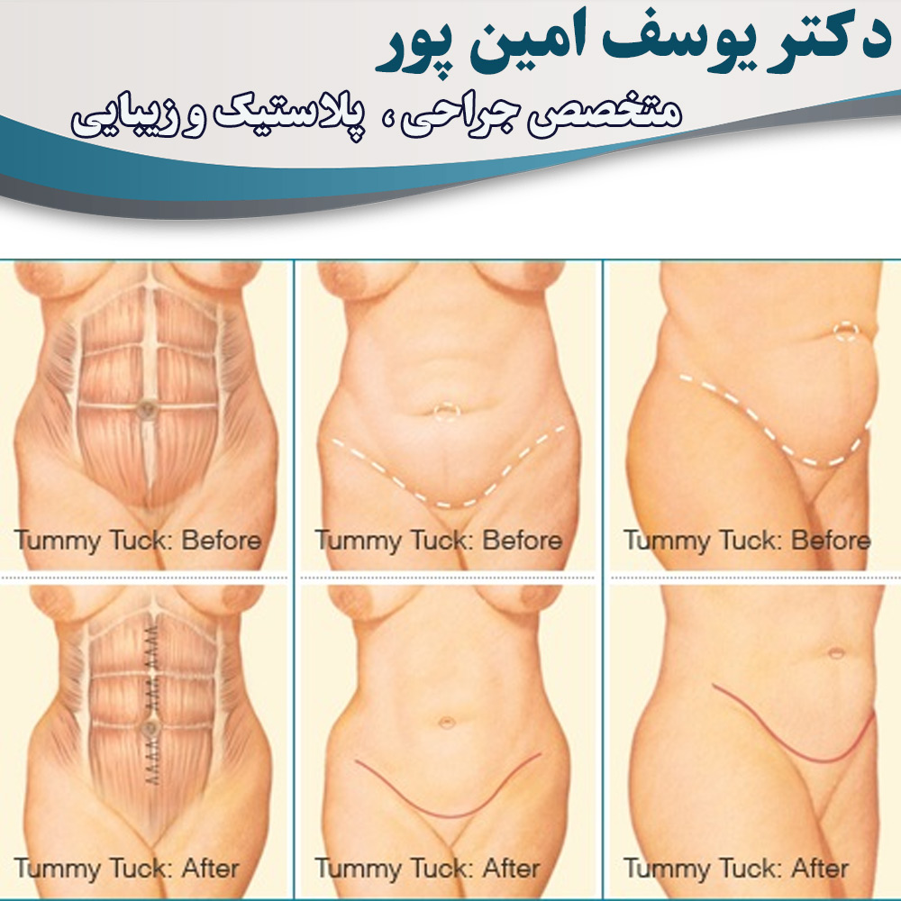 abdominoplasty-in-urmia